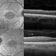 Título: Temporal retinal thinning in Alport Syndrome 